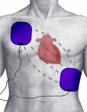 Defibrillering Defibrillering